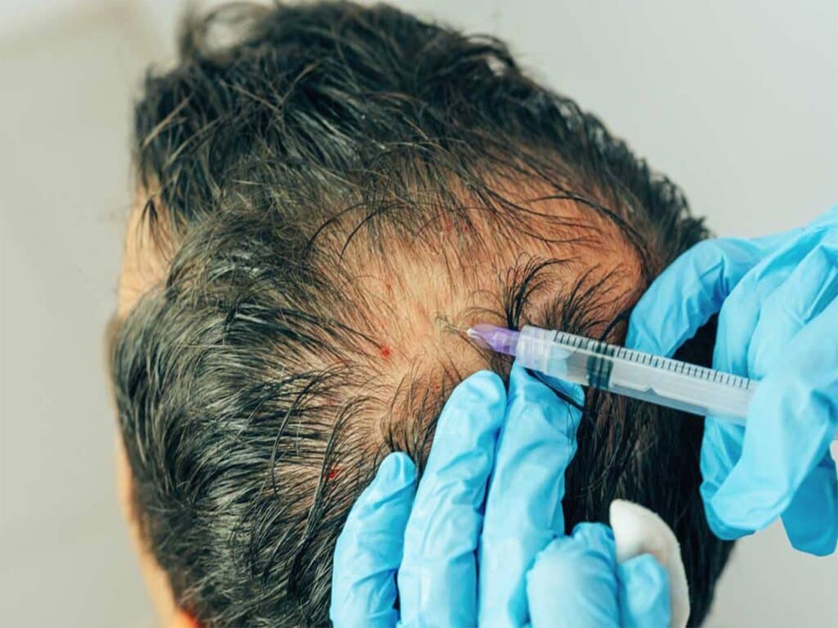 PRP Hair Restoration